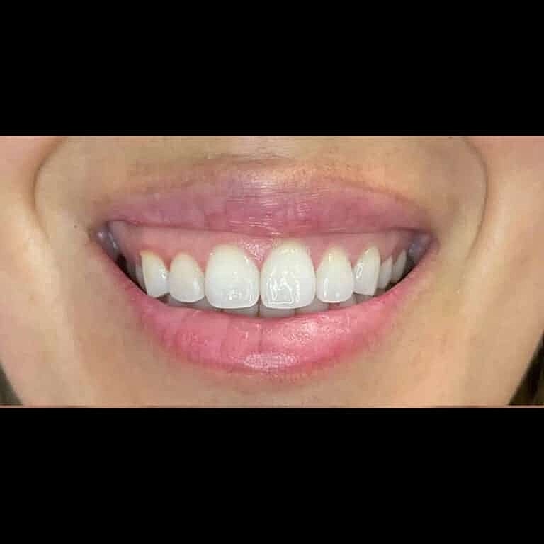 Dermal Fillers Before & After