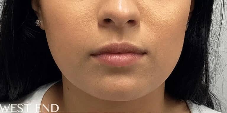 Dermal Fillers Before & After