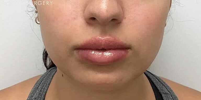 Dermal Fillers Before & After