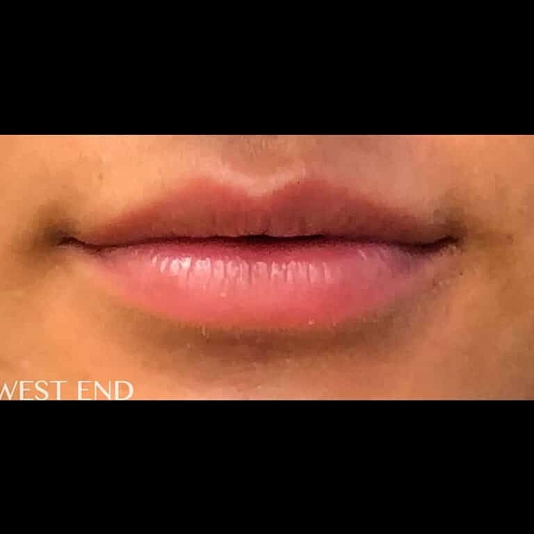 Dermal Fillers Before & After