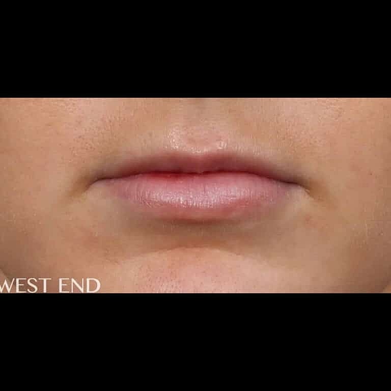 Dermal Fillers Before & After