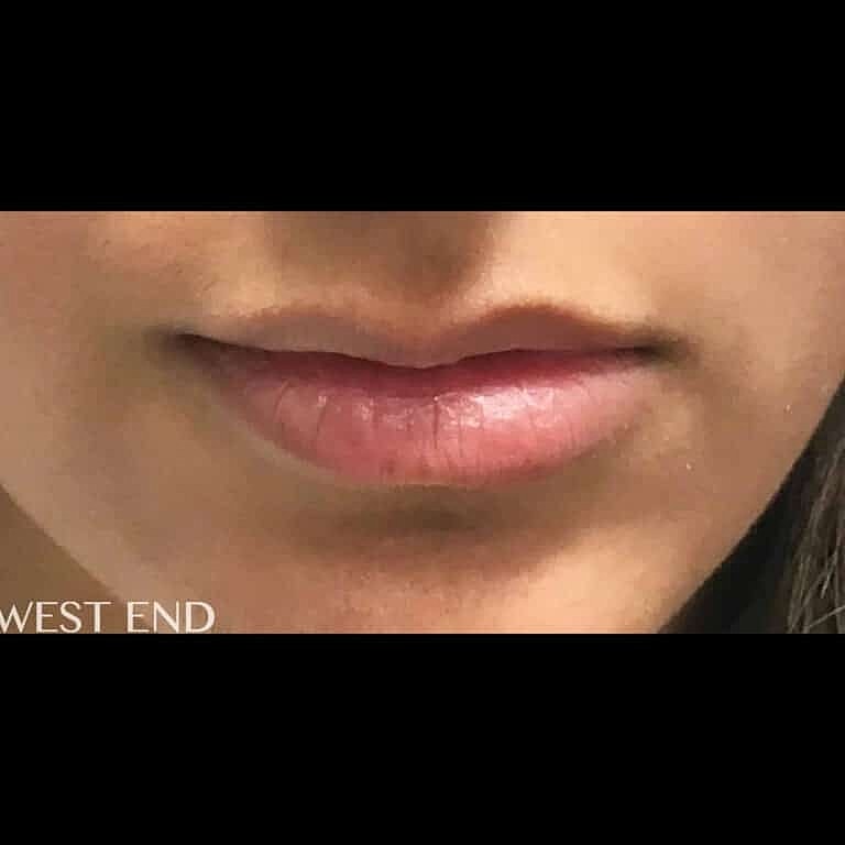 Dermal Fillers Before & After