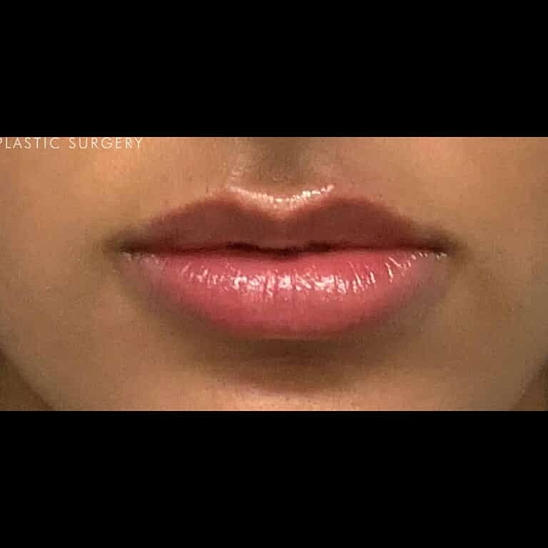 Dermal Fillers Before & After