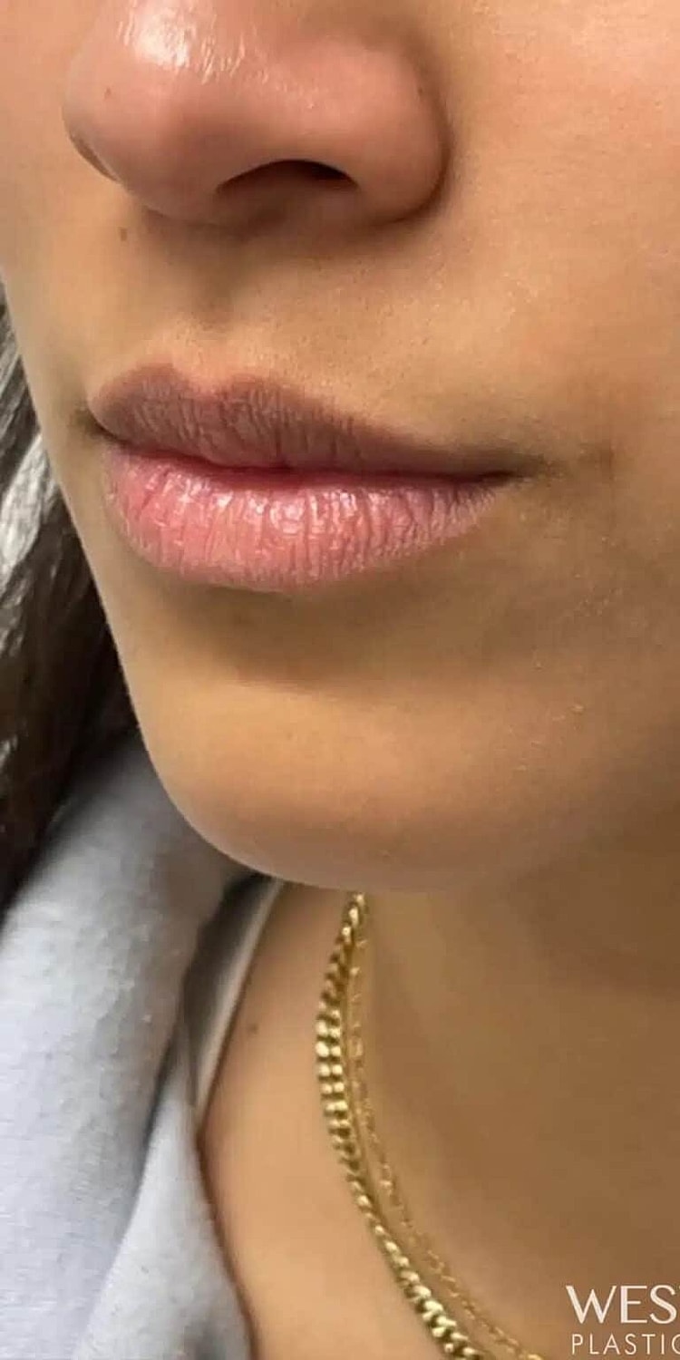 Dermal Fillers Before & After