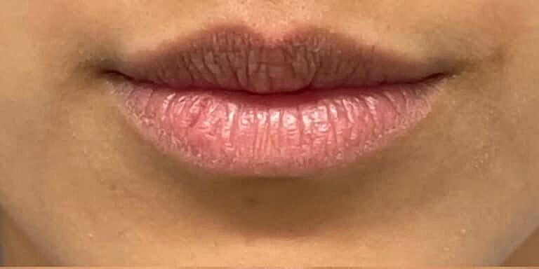 Dermal Fillers Before & After