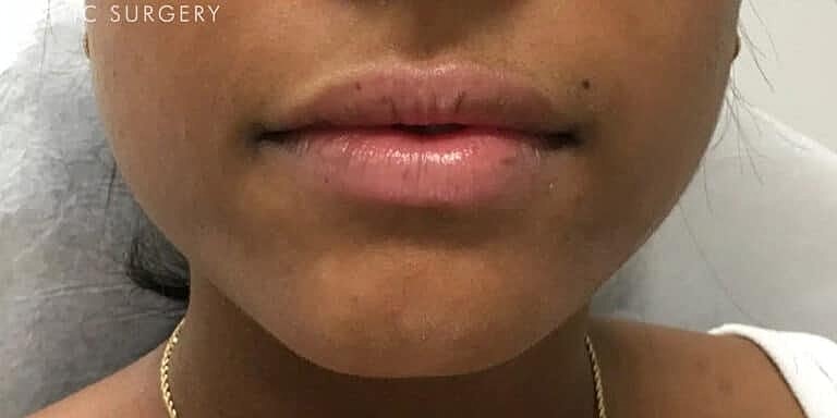 Dermal Fillers Before & After