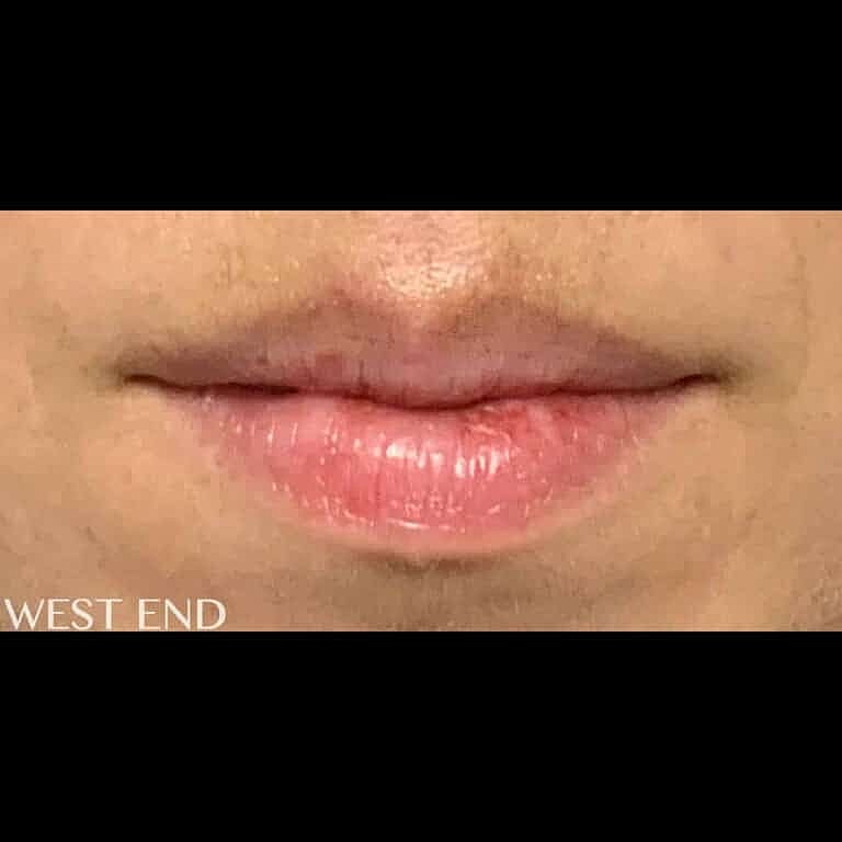 Dermal Fillers Before & After