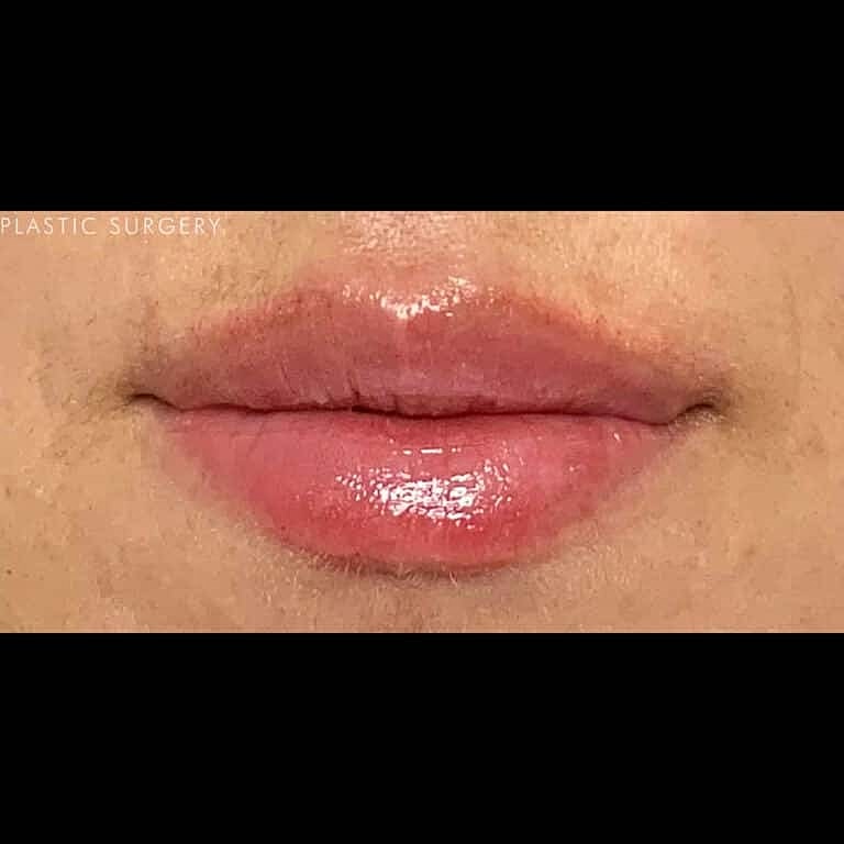 Dermal Fillers Before & After