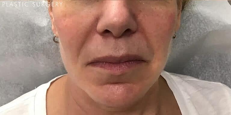 Dermal Fillers Before & After