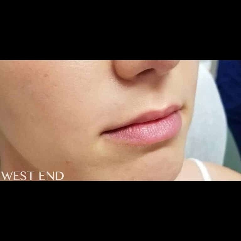 Dermal Fillers Before & After