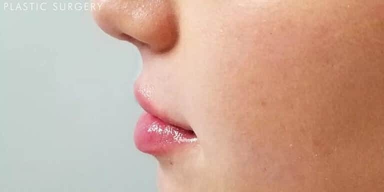Dermal Fillers Before & After