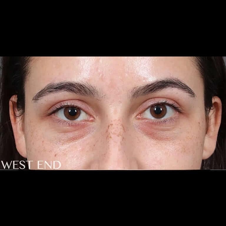 Dermal Fillers Before & After