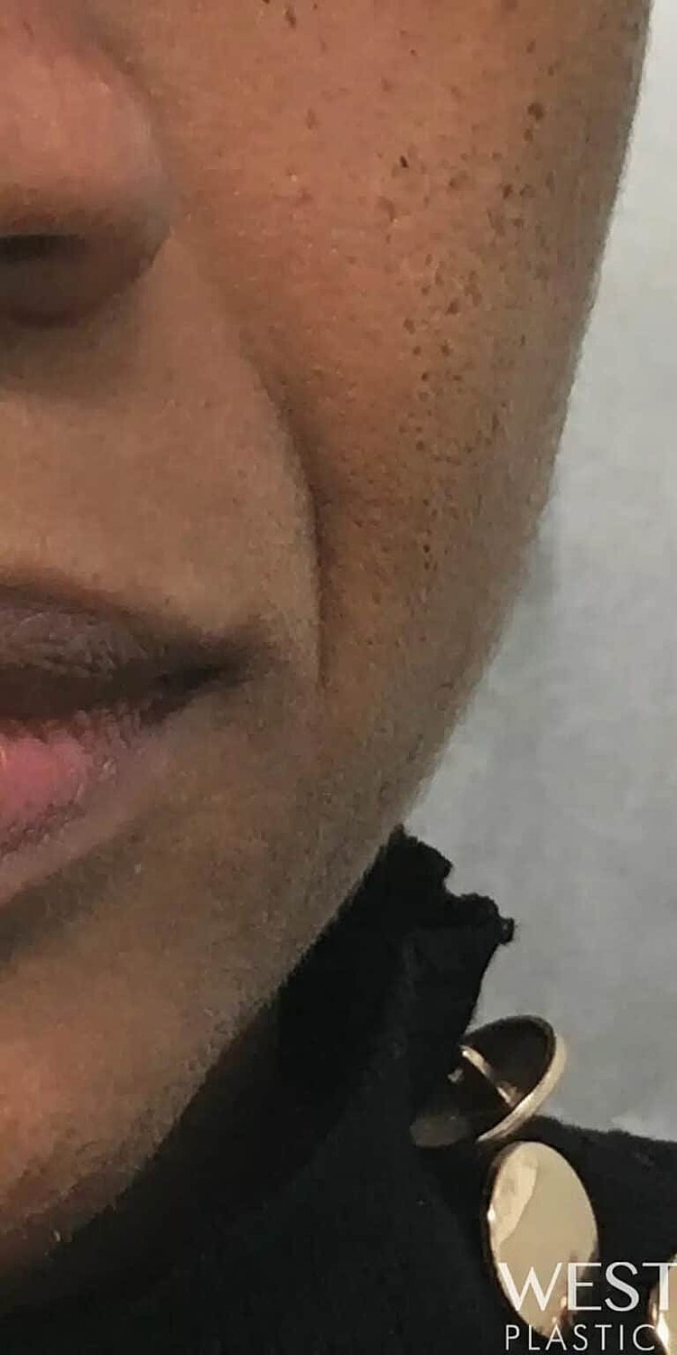 Dermal Fillers Before & After