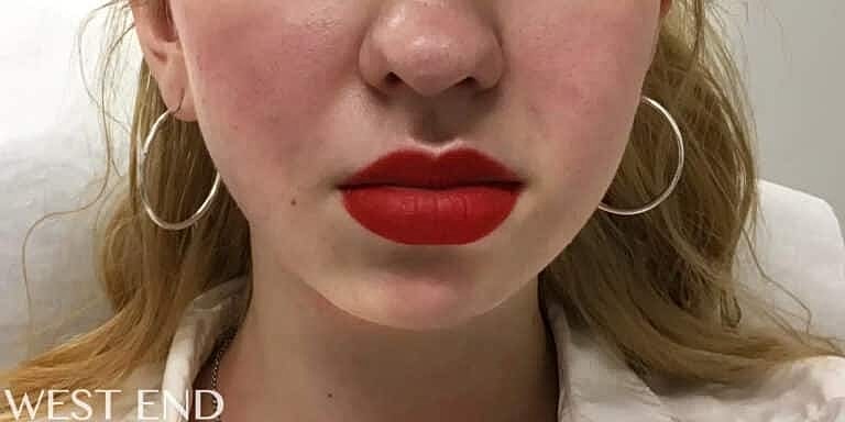 Dermal Fillers Before & After