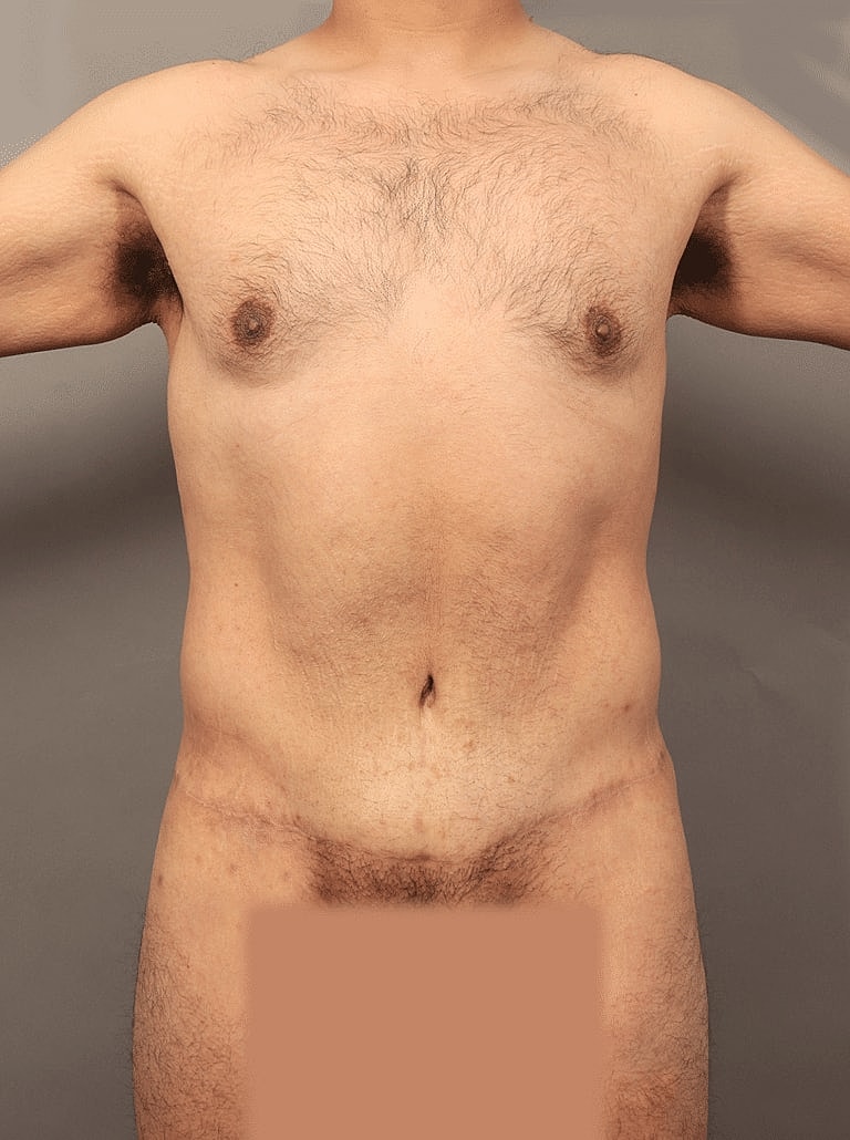 Post Weight Loss Before & After