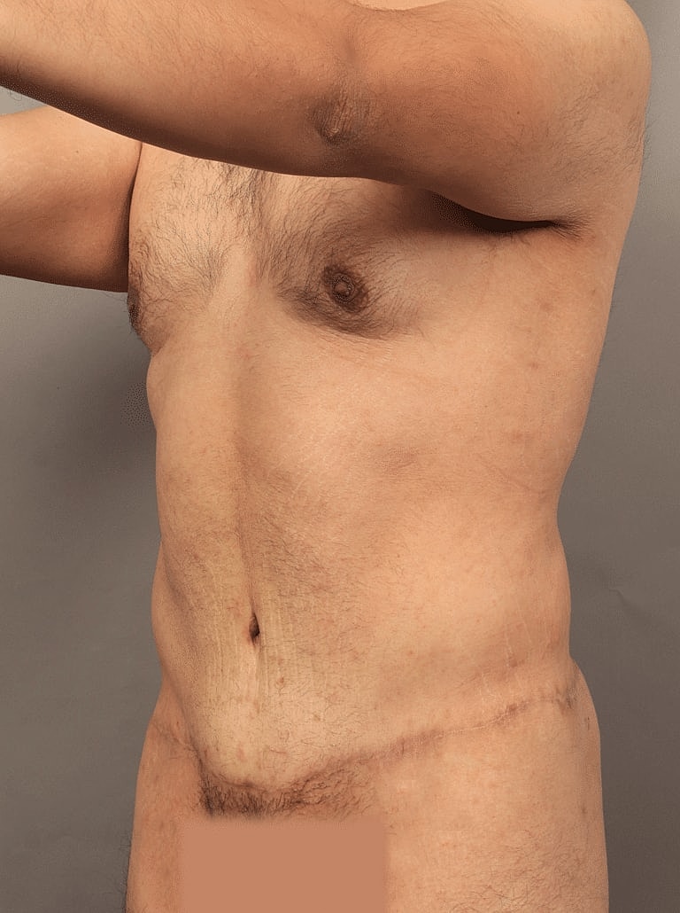 Post Weight Loss Before & After
