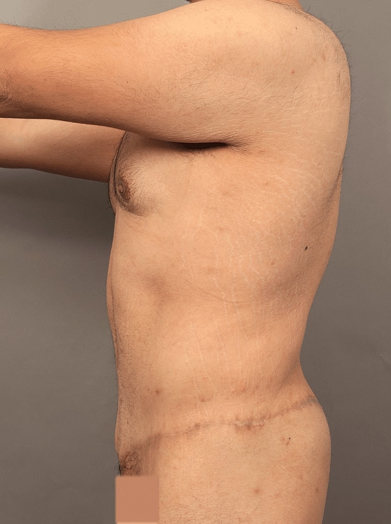 Post Weight Loss Before & After