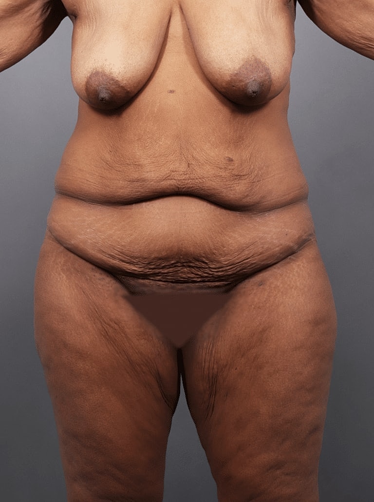 Post Weight Loss Before & After