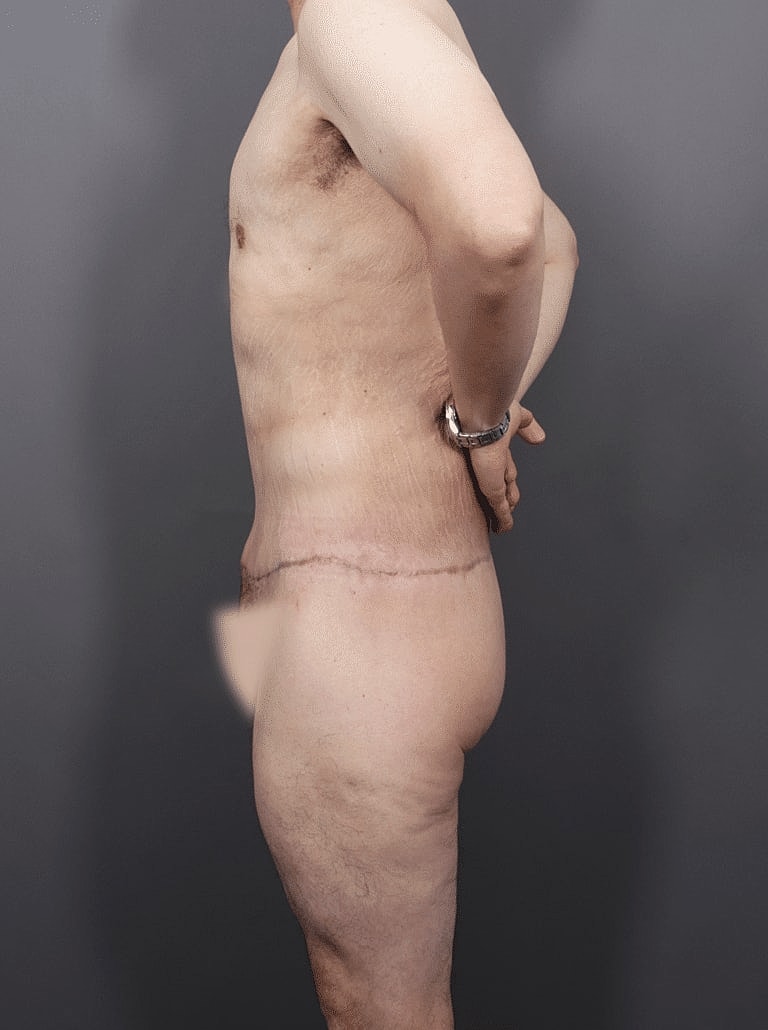 Post Weight Loss Before & After