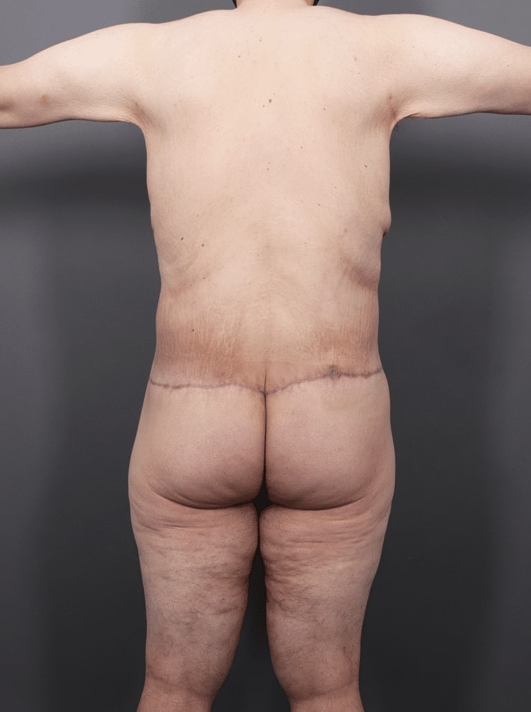 Post Weight Loss Before & After