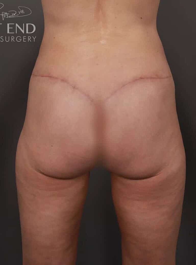 Post Weight Loss Before & After