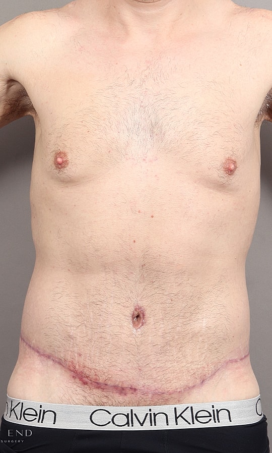 Post Weight Loss Before & After