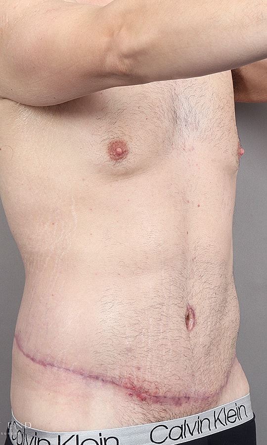 Post Weight Loss Before & After