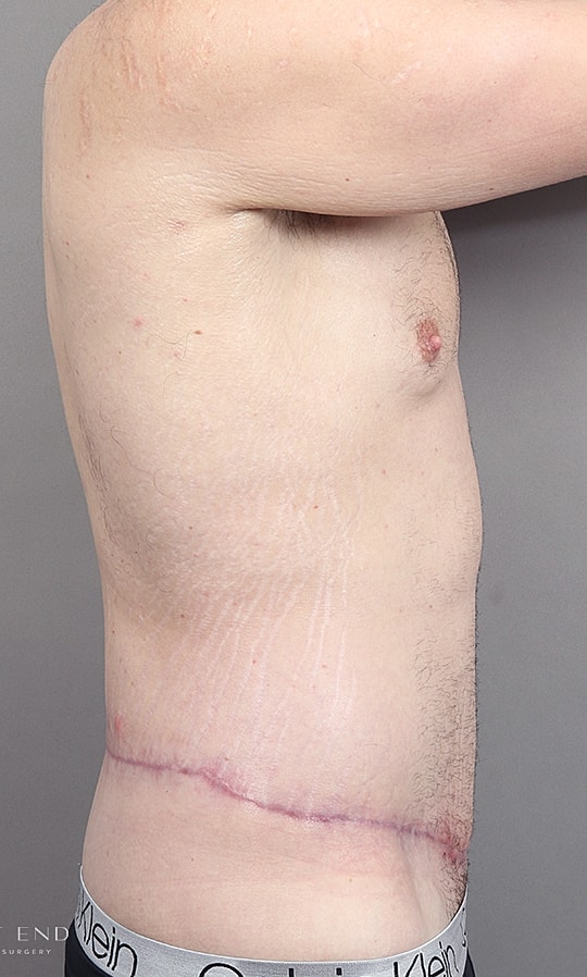 Post Weight Loss Before & After