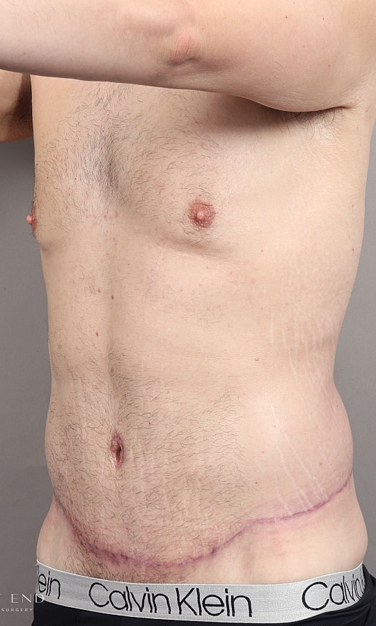 Post Weight Loss Before & After