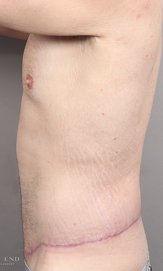 Post Weight Loss Before & After