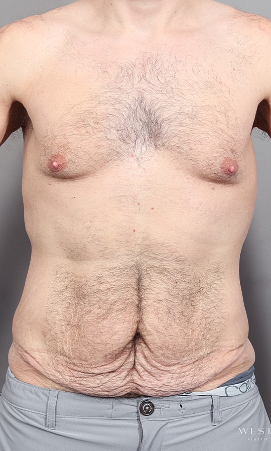 Post Weight Loss Before & After