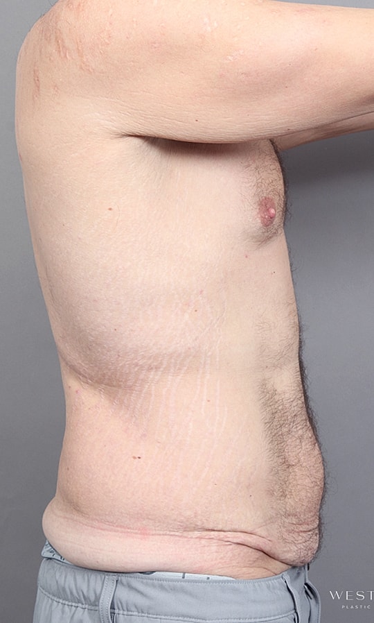 Post Weight Loss Before & After