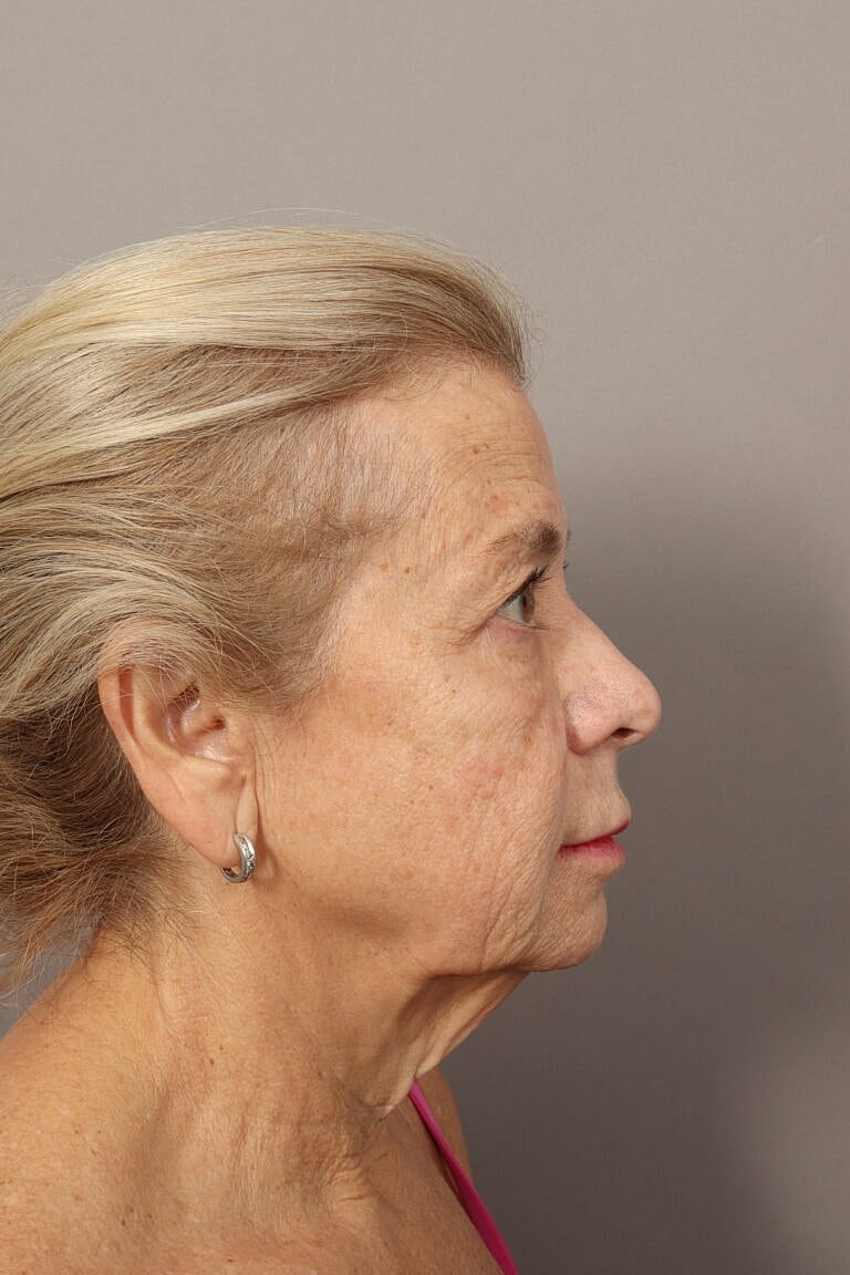 Facial Fat Transfer Before & After