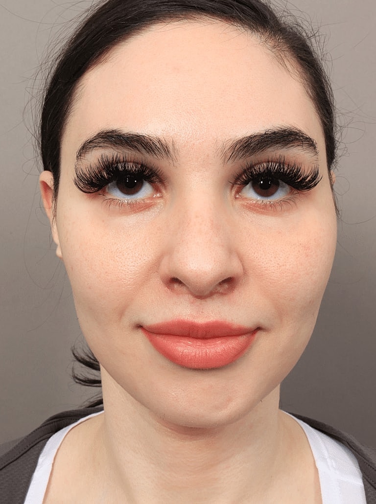 Facial Fat Transfer Before & After