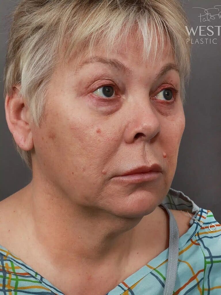 Facial Fat Transfer Before & After