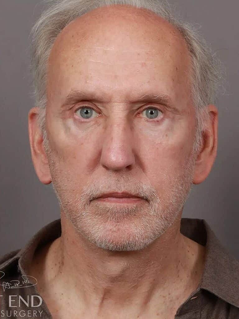 Facial Fat Transfer Before & After