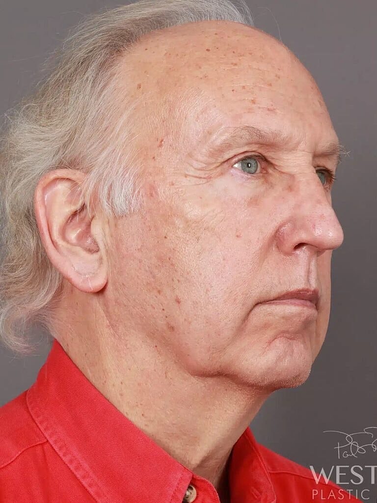 Facial Fat Transfer Before & After