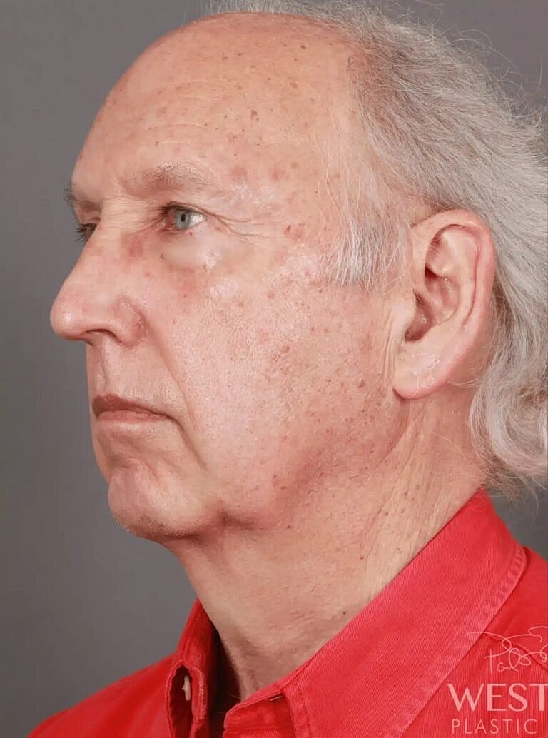 Facial Fat Transfer Before & After