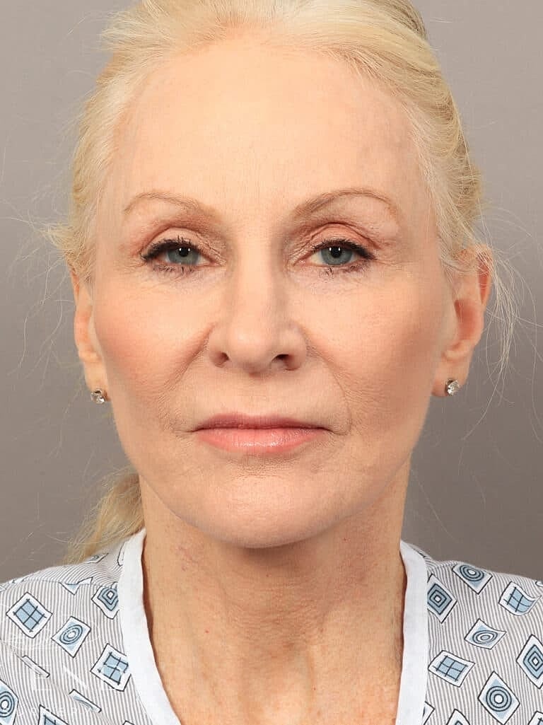 Facial Fat Transfer Before & After
