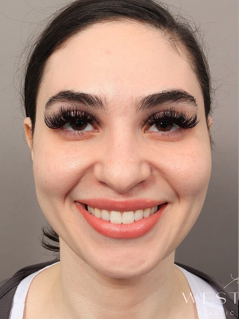 Facial Fat Transfer Before & After