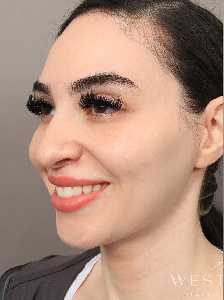 Facial Fat Transfer Before & After