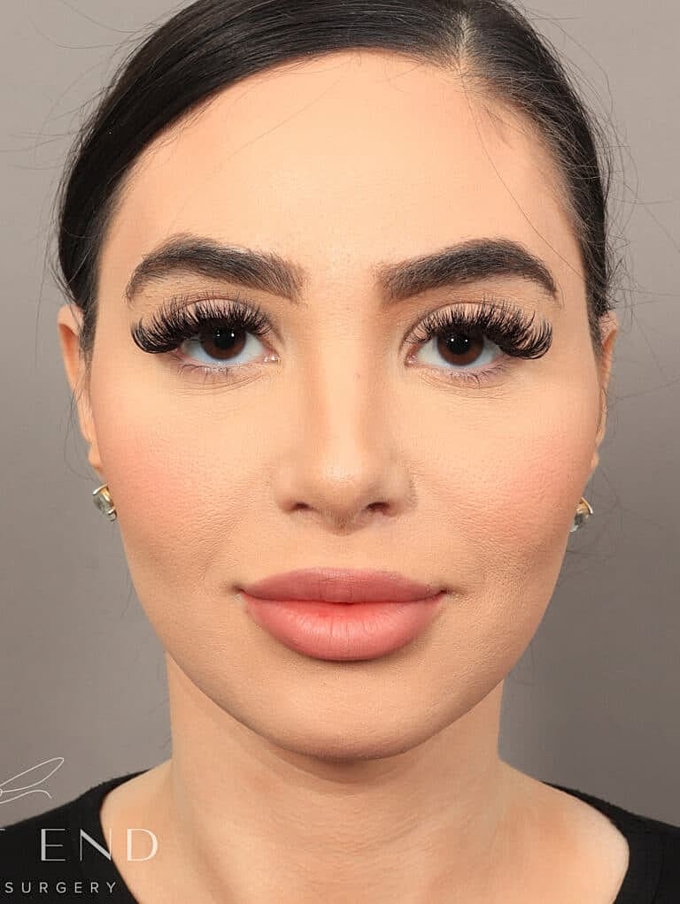 Facial Fat Transfer Before & After