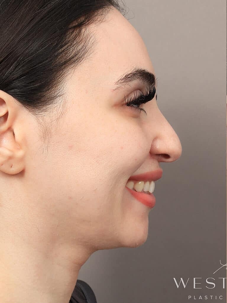 Facial Fat Transfer Before & After