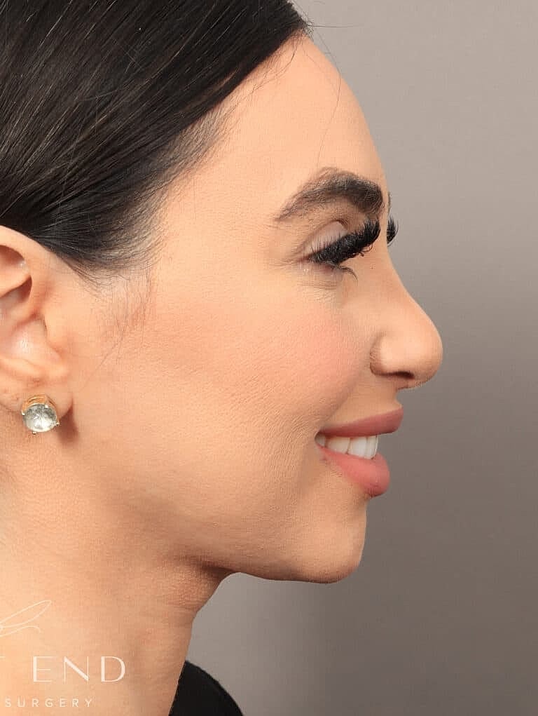 Facial Fat Transfer Before & After
