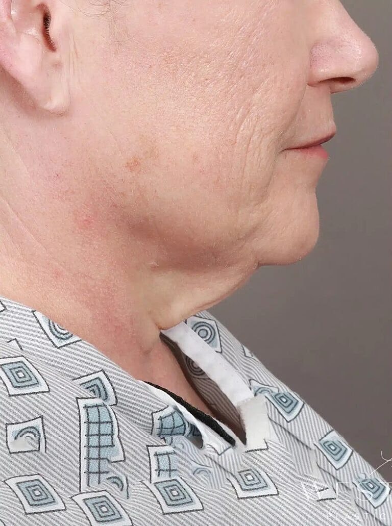 Facial Fat Transfer Before & After