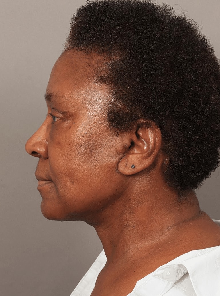 Facial Fat Transfer Before & After