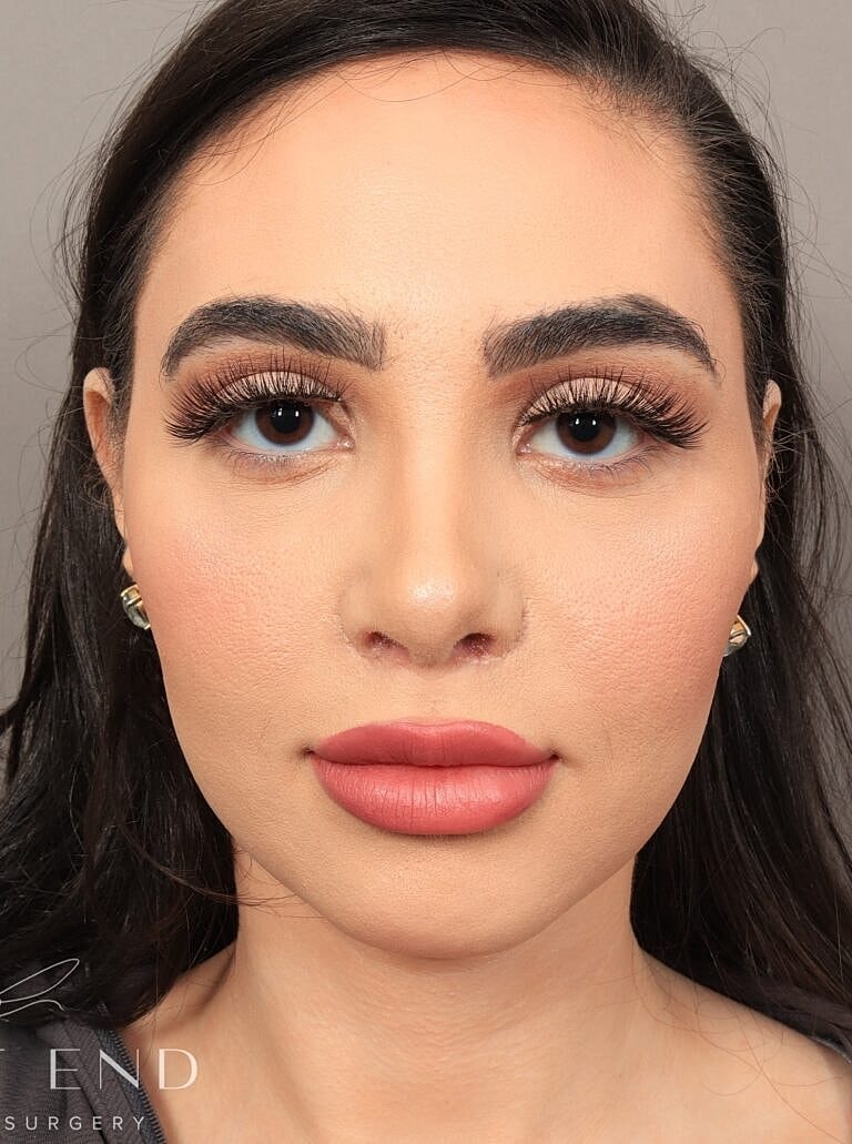 Facial Fat Transfer Before & After