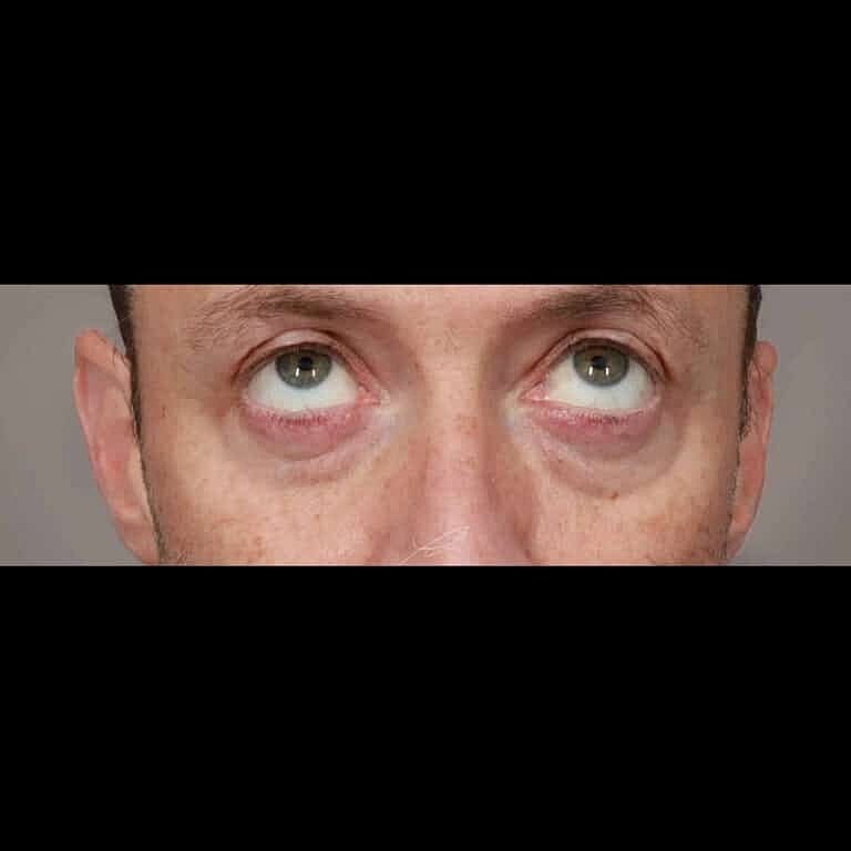 Facial Fat Transfer Before & After