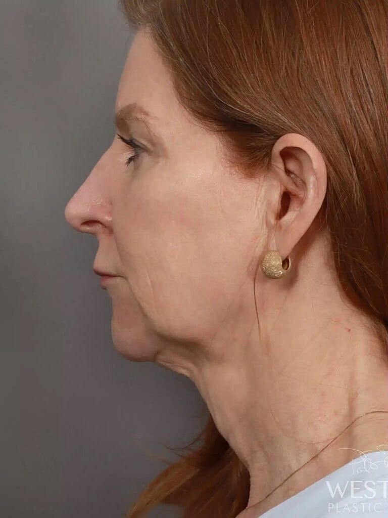 Facial Fat Transfer Before & After