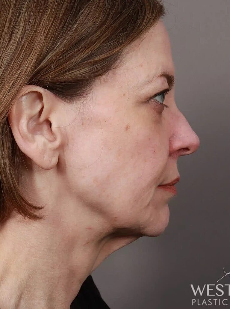 Facial Fat Transfer Before & After
